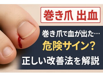 巻き爪じゅん 千葉駅前店/巻き爪で出血、正しい改善方法