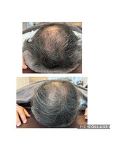 シェノン(Chainon)/スカルプケア