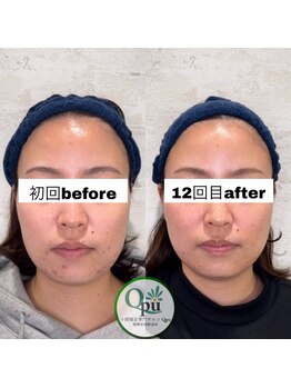 キュープ 相模原淵野辺店(Qpu)/たった4回で人生で1番小さな顔に