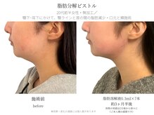 サボラミ(sabor A Mi)/顎ラインと首の間もスッキリ♪