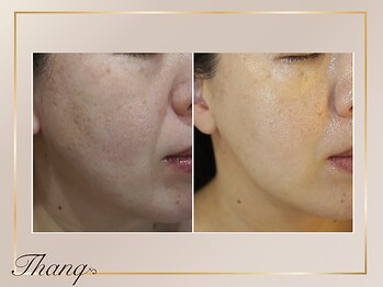 サンク(Thanq)の写真/たるみ毛穴を引き締めたいあなたへ!毛穴の開きをケアし、滑らか肌へ導きます♪