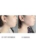 【お悩み改善/部位別】首のコリ・頬の緩み・目元の疲れラジオ波+EMS