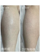 ニコリ(Nicori)/脱毛