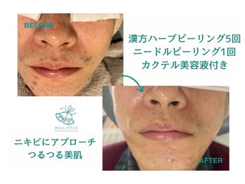 ベルスタイル(Bell style)/当店お客様症例(陶器ピーリング)