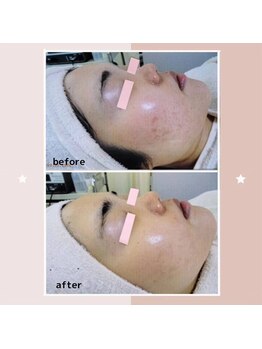 レゾン 京橋店/【ビフォーアフター】ニキビケア