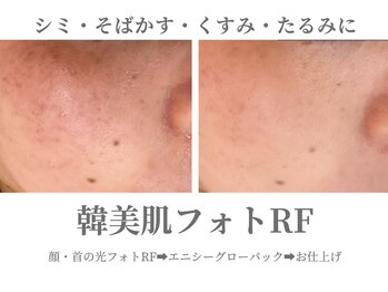 エクラ イオンモール徳島店(ECLAT)/韓美肌フォトRF+CO2パック