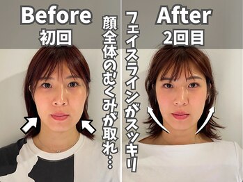 鍼灸整体院ユー(鍼灸整体院You...)/美容鍼×小顔矯正　施術後の変化