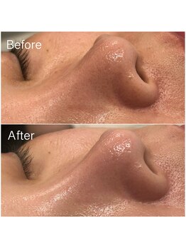 ジョアアンジェ 京橋店(joie ange)/毛穴ケア