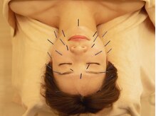 大人気美容鍼灸♪細胞活性化電機施術で、リフトアップを叶える◎