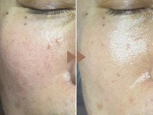 ドゥナ(DUNA)/7日間肌コース