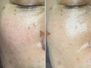 ドゥナ(DUNA)/7日間肌コース