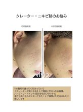 ヴィヴィオドット(vivio.)/ハーブピーリング