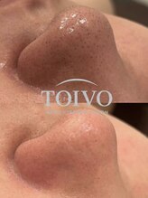 トイヴォ(TOIVO)/毛穴洗浄ビフォーアフター！