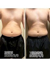 クールスパ(COOL SPA)/【20代男性】お腹症例