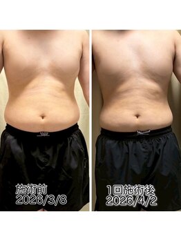 クールスパ(COOL SPA)/【20代男性】お腹症例