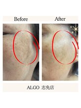 アルゴ 志免店(ALGO)/光フォトでお悩み解決！