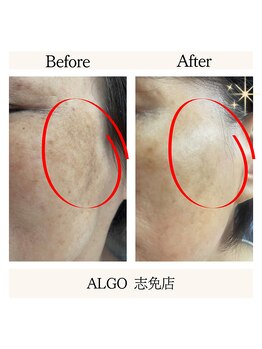 アルゴ 志免店(ALGO)/光フォトでお悩み解決！