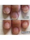 60代　縦筋