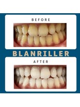 ブランリエ 天王寺阿倍野店(BLANRILLER)/セルフホワイトニング