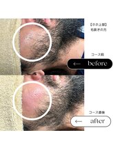 エスト(Est_.)/美容電気脱毛【ホホ上部】