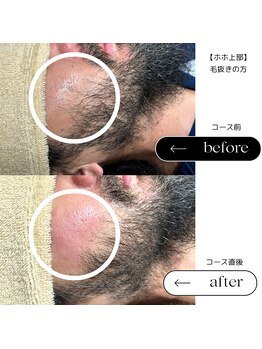 エスト(Est_.)/美容電気脱毛【ホホ上部】