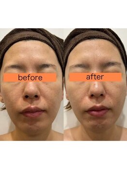 サクラ スパ(SAKURA SPA)/ハーブピーリングコース