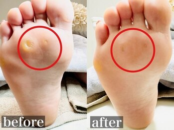 しあん 京都/何年も抱えてた魚の目!