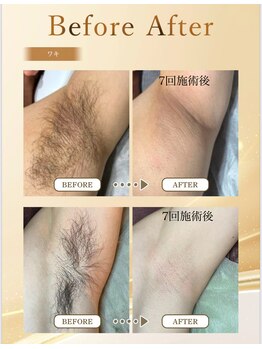 セルカ(CELCA)/メンズワキ　before after