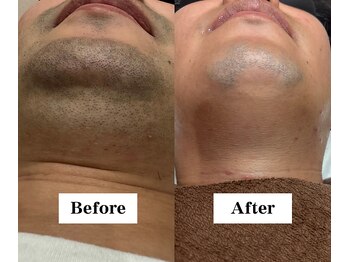 ワイイーサロン(Y/E SALON)/【20代男性　顔脱毛】