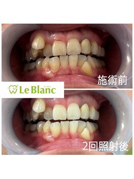 ルブラン 奈良店(Le Blanc)/年内に駆け込みホワイトニング