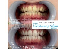 ホワイトニングサロン 福岡天神店/ホワイトニング