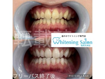 ホワイトニングサロン 福岡天神店/ホワイトニング