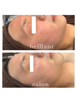 ブレリアントサロン 池袋店(brillant salon)/【30代男性】毛穴洗浄
