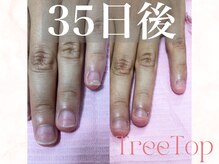 ツリートップ(Tree Top)/深爪矯正