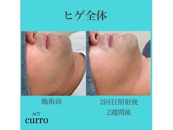 アクト クロ(ACT curro)/【ヒゲ全体】脱毛施術例