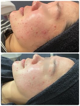 ニコリ(Nicori)/ハーブピーリング