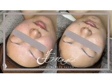 ビーマジック(美magic)/ララピール症例