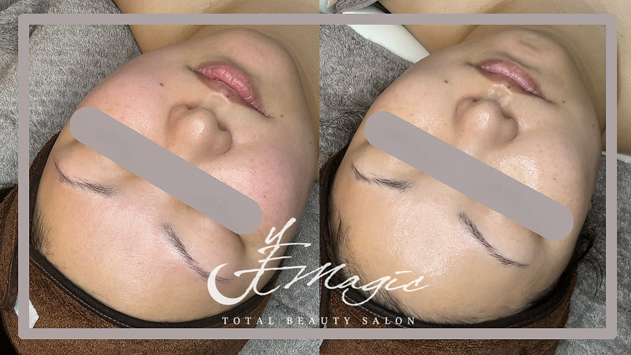 ビーマジック(美magic)/ララピール症例