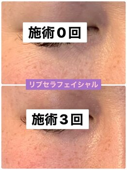 プリュネル(Prunelle)/プラズマシャワー