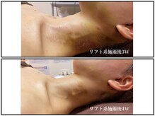 インディラグゼ 麻布十番/インディバフェイシャル