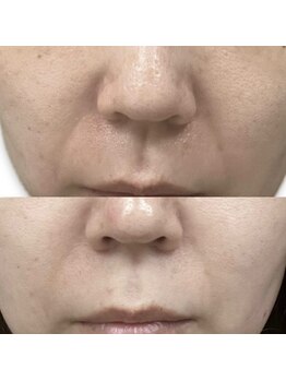 フェリス(feliz)/美白、ほうれいせんに◎[白石区]