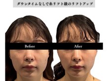 アロエベル(aloe Belle)/Before After（1回施術）