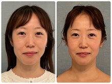 カナエルサロン 旭川(KANAERU SALON)/【小顔ケア】症例☆