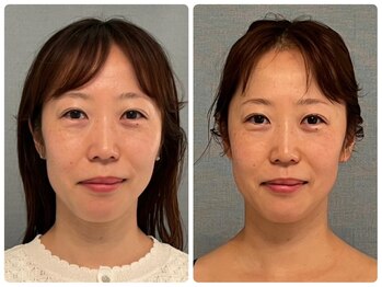 カナエルサロン 旭川(KANAERU SALON)/【小顔ケア】症例☆