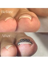 巻き爪矯正センター 沖縄 宜野湾/軽度巻き爪矯正ビフォーアフター