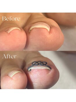 巻き爪矯正センター 沖縄 宜野湾/軽度巻き爪矯正ビフォーアフター