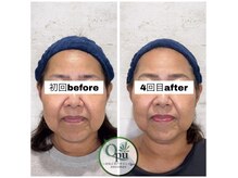 キュープ 相模原淵野辺店(Qpu)/たった4回で人生で1番小さな顔に