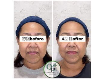 キュープ 相模原淵野辺店(Qpu)/たった4回で人生で1番小さな顔に