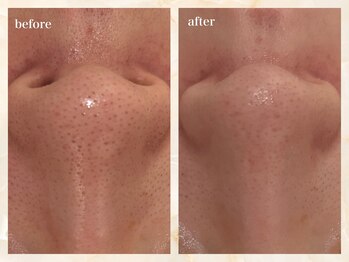 セーラマーレ(cera-mare Esthetic by CARDIA)の写真/毛穴の黒ずみ・開きに集中ケア！ララピール×光脱毛でつるん肌へ