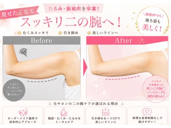 ヨサパーク アンジュ 千早店(YOSA PARK Ange)の写真/自分では落としづらい二の腕や背中のハミ肉はプロにお任せ◎ルルオンとリンパケアで脂肪を柔らかくして分解